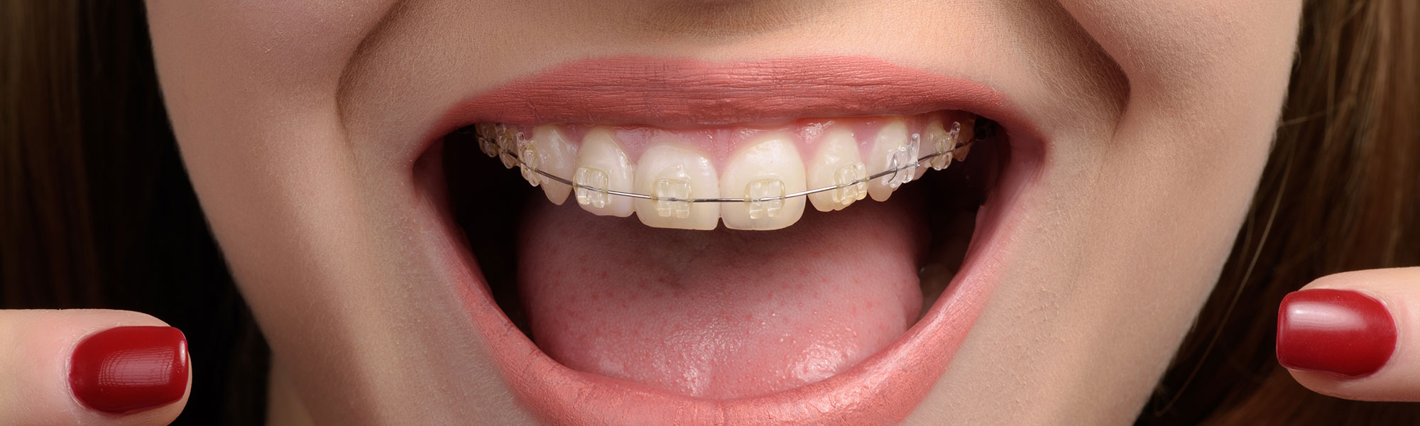 Ceramic Braces Long Beach CA