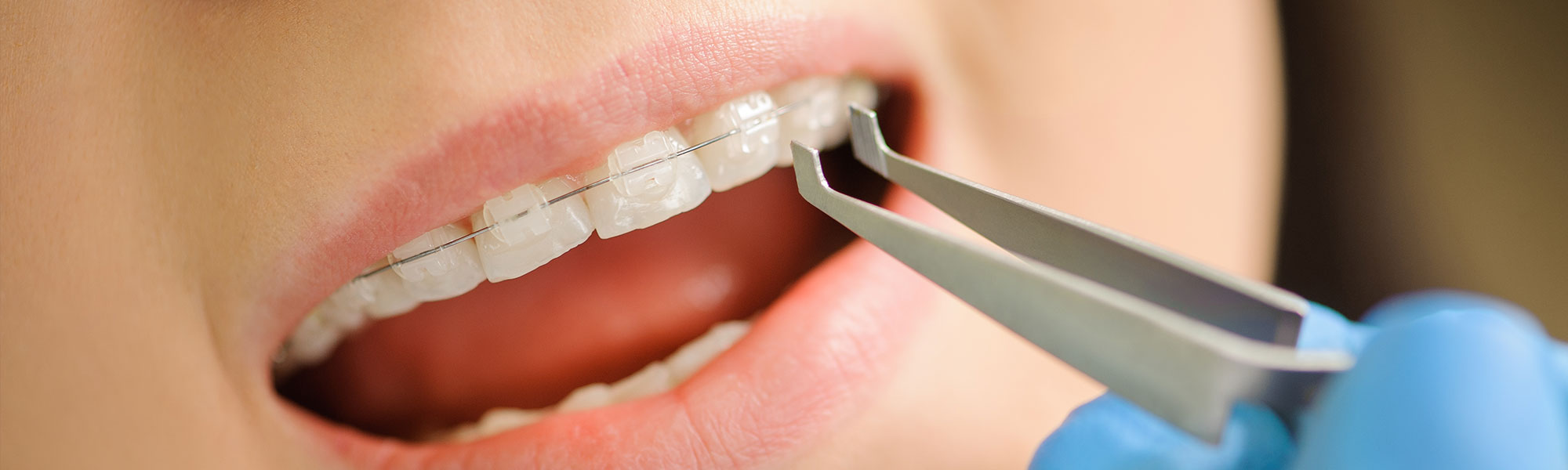 Porcelain Ceramic Braces Treatment in Long Beach CA