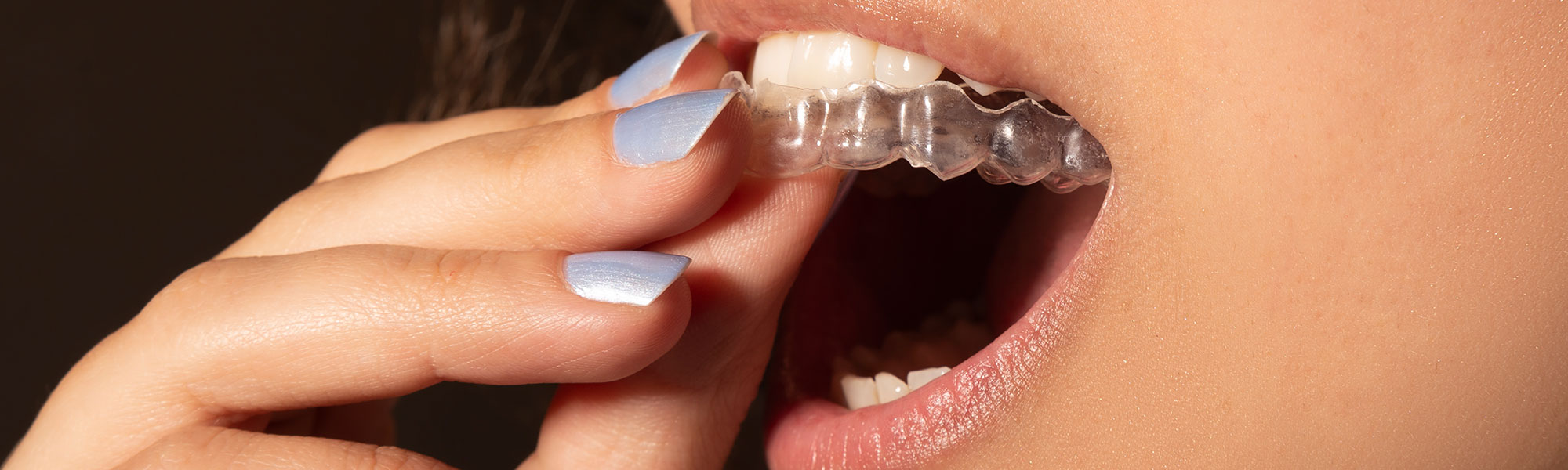 Orthodontics Retainers Long Beach CA